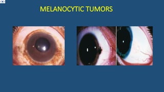 MELANOCYTIC TUMORS
 