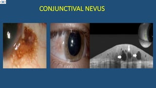 CONJUNCTIVAL NEVUS
 