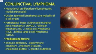 CONJUNCTIVAL LYMPHOMA
• Monoclonal proliferation of lymphocytes
(nodal,extranodal)
• Ocular adenexal lymphomas are typically of
B cell origin
• Pathological Types : Extranodal marginal
zone lymphoma ( ENMZL) , Follicular
lymphoma (FL) , Mantle cell lymphoma
(MCL) , Diffuse large B cell lymphoma
(DLBCL)
• Predisposing factors :
• Immune deficiency , autoimmune
conditions , infections (H.pylori ,
chalamydia psittaci ) , genetic mutations
 
