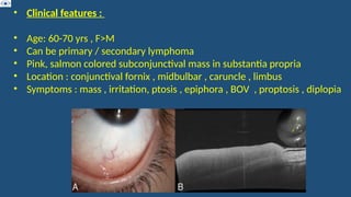 • Clinical features :
• Age: 60-70 yrs , F>M
• Can be primary / secondary lymphoma
• Pink, salmon colored subconjunctival mass in substantia propria
• Location : conjunctival fornix , midbulbar , caruncle , limbus
• Symptoms : mass , irritation, ptosis , epiphora , BOV , proptosis , diplopia
 