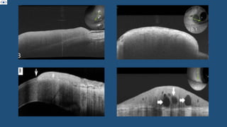 CONJUNCTIVAL TUMORS . TYPES , CLASSIFICATION , CLINICAL FEATURES . MANAGEMENT