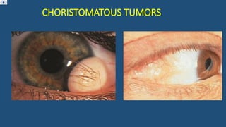 CHORISTOMATOUS TUMORS
 