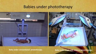 Babies under phototherapy
Baby under conventional phototherapy Baby under triple unit intense phototherapy
 