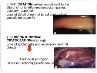  C. Source of infection: Conjunctival discharge of
the affected person
 D. Modes of infection:
 1. Direct spread (Air, ...