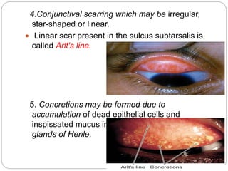  4. TT: Trachomatous trichiasis. TT is labelled
when at least one eyelash rubs the eyeball.
 
