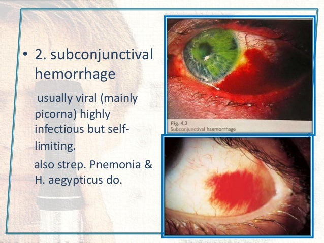 Conjuctival diseases