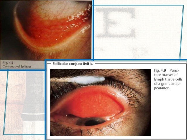 Conjuctival diseases