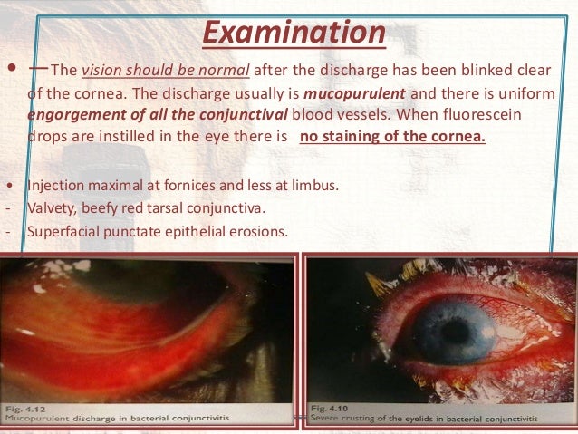 Conjuctival diseases