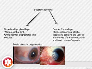 Substantia propria
Superficial lymphoid layer
•Not present at birth
•Lymphocytes aggregrated into
nodules
Deeper fibrous layer
•thick, collagenous, elastic
tissue and contains the vessels
and nerves of the conjunctiva in
addition to Krause's glands
Senile elastotic degeneration
 