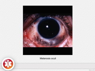 Melanosis oculi
 