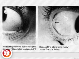 Medical region of the eye showing the
caruncle (C) and plica semilunaris (P)
Region of the lateral fornix (arrow)
14 mm from the limbus
 