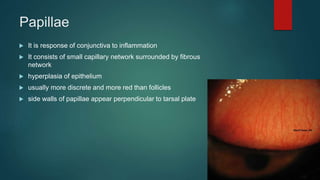 Papillae
 It is response of conjunctiva to inflammation
 It consists of small capillary network surrounded by fibrous
network
 hyperplasia of epithelium
 usually more discrete and more red than follicles
 side walls of papillae appear perpendicular to tarsal plate
 