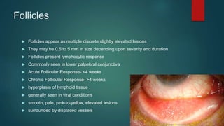 Follicles
 Follicles appear as multiple discrete slightly elevated lesions
 They may be 0.5 to 5 mm in size depending upon severity and duration
 Follicles present lymphocytic response
 Commonly seen in lower palpebral conjunctiva
 Acute Follicular Response- <4 weeks
 Chronic Follicular Response- >4 weeks
 hyperplasia of lymphoid tissue
 generally seen in viral conditions
 smooth, pale, pink-to-yellow, elevated lesions
 surrounded by displaced vessels
 