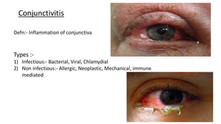 Conjunctivitis
Defn:- Inflammation of conjunctiva
Types :-
1) Infectious:- Bacterial, Viral, Chlamydial
2) Non infectious:- Allergic, Neoplastic, Mechanical, immune
mediated
 