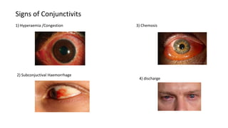 Signs of Conjunctivits
1) Hyperaemia /Congestion
2) Subconjuctival Haemorrhage
3) Chemosis
4) discharge
 