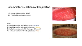 Inflammatory reactions of Conjunctiva
1) Papillae (hypertrophied vessel)
2) Follicles (lymphatic aggregates)
Note:-
1) Papillary reaction with MP discharge:- Bacterial
2) Papillary reaction with watery discharge:- Allergic
3) Follicular reaction with MP discharge:- Chlamydial
4) Follicular reaction with watery discharge:- Viral
 