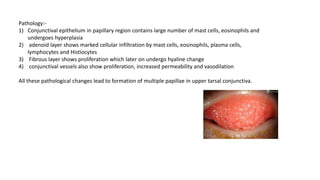 Pathology:-
1) Conjunctival epithelium in papillary region contains large number of mast cells, eosinophils and
undergoes hyperplasia
2) adenoid layer shows marked cellular infiltration by mast cells, eosinophils, plasma cells,
lymphocytes and Histiocytes
3) Fibrous layer shows proliferation which later on undergo hyaline change
4) conjunctival vessels also show proliferation, increased permeability and vasodilation
All these pathological changes lead to formation of multiple papillae in upper tarsal conjunctiva.
 