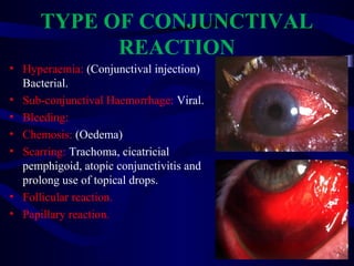 TYPE OF CONJUNCTIVAL
REACTION
• Hyperaemia: (Conjunctival injection)
Bacterial.
• Sub-conjunctival Haemorrhage: Viral.
• Bleeding:
• Chemosis: (Oedema)
• Scarring: Trachoma, cicatricial
pemphigoid, atopic conjunctivitis and
prolong use of topical drops.
• Follicular reaction.
• Papillary reaction.
 