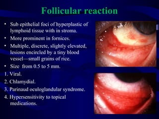 Follicular reaction
• Sub epithelial foci of hyperplastic of
lymphoid tissue with in stroma.
• More prominent in fornices.
• Multiple, discrete, slightly elevated,
lesions encircled by a tiny blood
vessel—small grains of rice.
• Size from 0.5 to 5 mm.
1. Viral.
2. Chlamydial.
3. Parinaud oculoglandular syndrome.
4. Hypersensitivity to topical
medications.
 