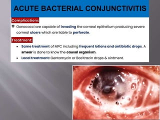 ACUTE BACTERIAL CONJUNCTIVITIS