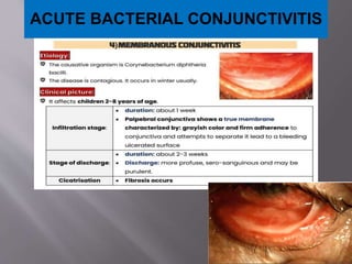 ACUTE BACTERIAL CONJUNCTIVITIS