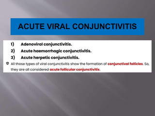 ACUTE VIRAL CONJUNCTIVITIS