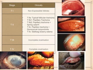 Stage Clinically
T I Non-Expressible follicles
T II
• T IIa: Typical follicular trachoma
• T IIb1: Papillary Trachoma
• T IIb2: Papillary trachoma +
Spring catarrh
• T IIc: Papillary trachoma +
Gonococcal conjunctivitis
• T IIv: Stellwag brawny edema
T III Incomplete cicatrisation
T IV Complete cicatrisation