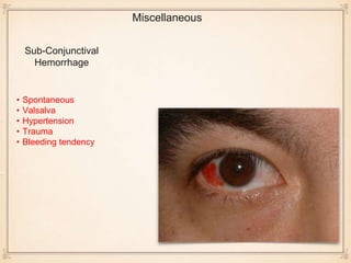 Sub-Conjunctival
Hemorrhage
• Spontaneous
• Valsalva
• Hypertension
• Trauma
• Bleeding tendency
Miscellaneous