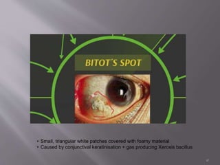 47
• Small, triangular white patches covered with foamy material
• Caused by conjunctival keratinisation + gas producing Xerosis bacillus