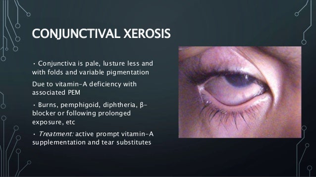 Common Conjunctival Conditions