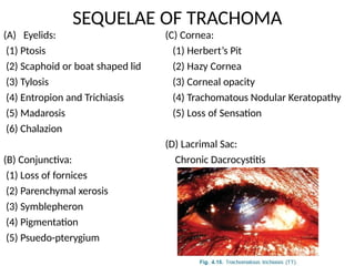 Trachom Conjunctiva Lectures conjunctivitis. Pptx | PPTX