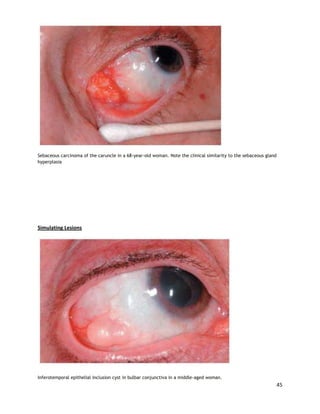 Conjunctival tumors | DOCX