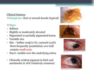 Conjunctival tumors | PPTX