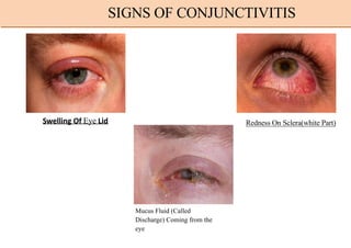 Swelling Of Eye Lid Redness On Sclera(white Part)
Mucus Fluid (Called
Discharge) Coming from the
eye
SIGNS OF CONJUNCTIVITIS
 