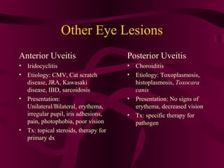 Other Eye Lesions
Anterior Uveitis
• Iridocyclitis
• Etiology: CMV, Cat scratch
disease, JRA, Kawasaki
disease, IBD, sarcoidosis
• Presentation:
Unilateral/Bilateral, erythema,
irregular pupil, iris adhesions,
pain, photophobia, poor vision
• Tx: topical steroids, therapy for
primary dx
Posterior Uveitis
• Choroiditis
• Etiology: Toxoplasmosis,
histoplasmosis, Toxocara
canis
• Presentation: No signs of
erythema, decreased vision
• Tx: specific therapy for
pathogen
 