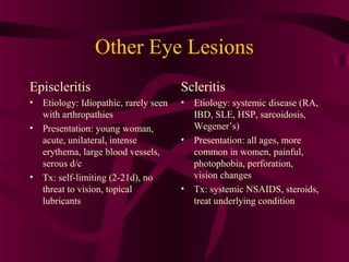 Other Eye Lesions
Episcleritis
• Etiology: Idiopathic, rarely seen
with arthropathies
• Presentation: young woman,
acute, unilateral, intense
erythema, large blood vessels,
serous d/c
• Tx: self-limiting (2-21d), no
threat to vision, topical
lubricants
Scleritis
• Etiology: systemic disease (RA,
IBD, SLE, HSP, sarcoidosis,
Wegener’s)
• Presentation: all ages, more
common in women, painful,
photophobia, perforation,
vision changes
• Tx: systemic NSAIDS, steroids,
treat underlying condition
 