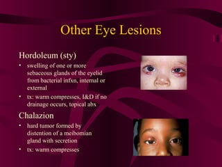 Other Eye Lesions
Hordoleum (sty)
• swelling of one or more
sebaceous glands of the eyelid
from bacterial infxn, internal or
external
• tx: warm compresses, I&D if no
drainage occurs, topical abx
Chalazion
• hard tumor formed by
distention of a meibomian
gland with secretion
• tx: warm compresses
 