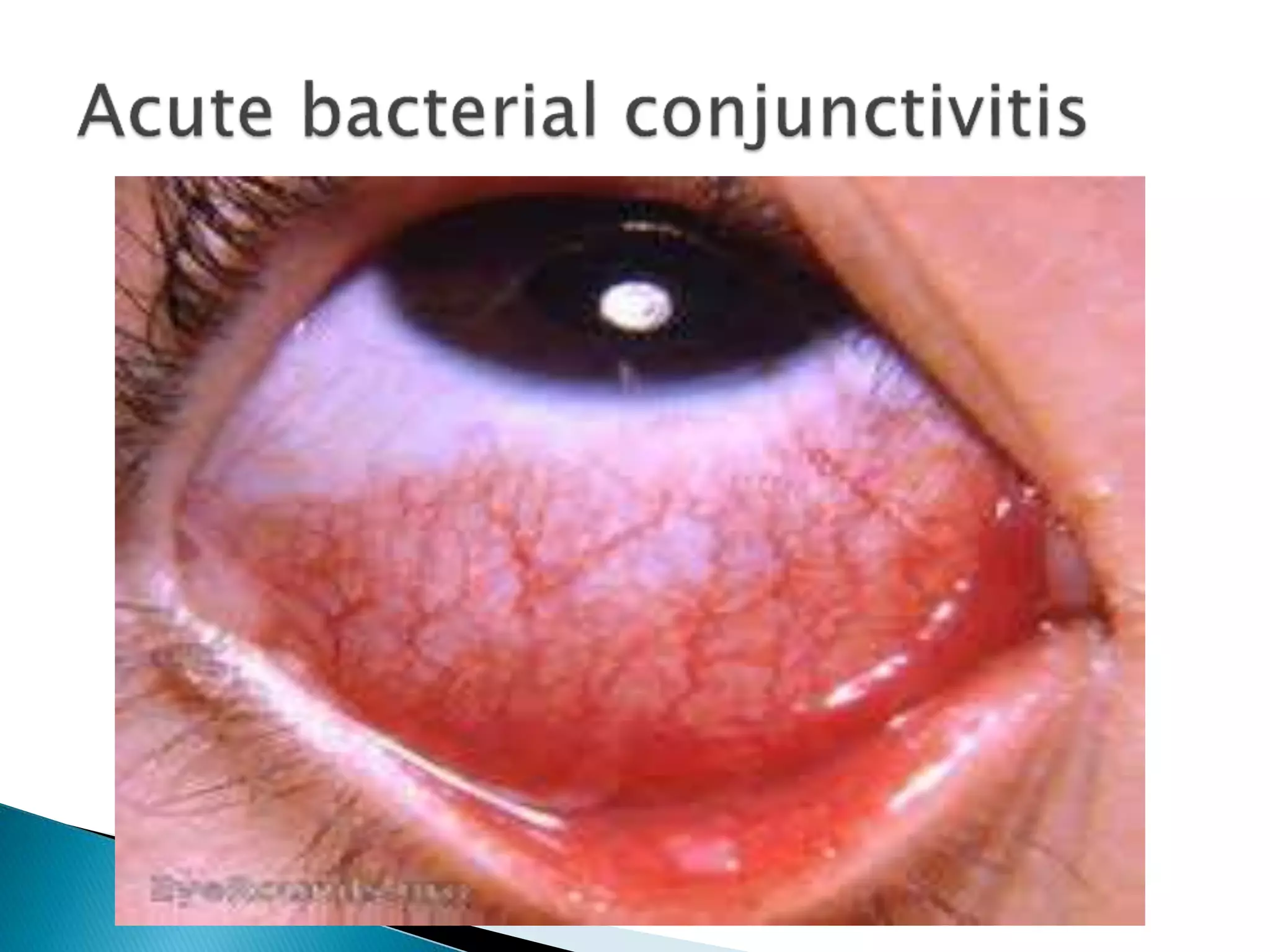 Conjunctivitis | PPTX