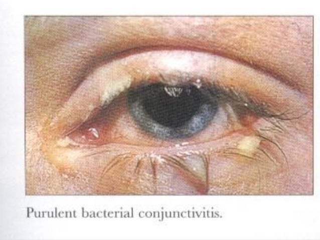 CONJUNCTIVITIS