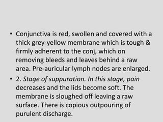 • Conjunctiva is red, swollen and covered with a
thick grey-yellow membrane which is tough &
firmly adherent to the conj, which on
removing bleeds and leaves behind a raw
area. Pre-auricular lymph nodes are enlarged.
• 2. Stage of suppuration. In this stage, pain
decreases and the lids become soft. The
membrane is sloughed off leaving a raw
surface. There is copious outpouring of
purulent discharge.
 