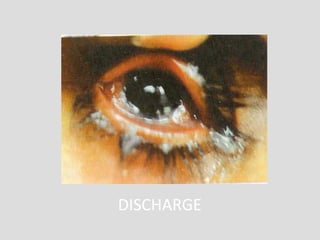 DISCHARGE
 