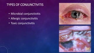 TYPES OF CONJUNCTIVITIS
• Microbial conjunctivitis
• Allergic conjunctivitis
• Toxic conjunctivitis
 