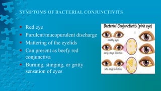 SYMPTOMS OF BACTERIAL CONJUNCTIVITS
 Red eye
 Purulent/mucopurulent discharge
 Mattering of the eyelids
 Can present as beefy red
conjunctiva
 Burning, stinging, or gritty
sensation of eyes
 