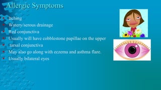  Itching
 Watery/serous drainage
 Red conjunctiva
 Usually will have cobblestone papillae on the upper
 tarsal conjunctiva
 May also go along with eczema and asthma flare.
 Usually bilateral eyes
 