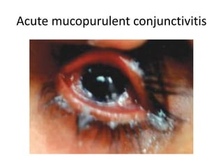 Conjunctivitis Slide 27