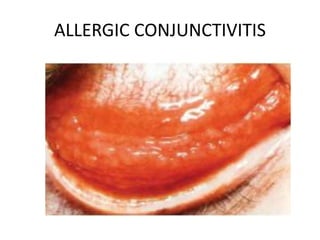 SIMPLE ALLERGIC CONJUNCTIVITIS
• It is a mild, non-specific allergic
conjunctivitis characterized by
itching, hyperaemia a...