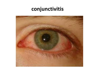 conjunctivitis
 