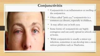Conjunctivitis
• Conjunctivitis is an inflammation or swelling of
the conjunctiva.
• Often called "pink eye," conjunctivitis is a
common eye disease, especially in children.
• It may affect one or both eyes.
• Some forms of conjunctivitis are highly
contagious and can easily spread in schools and
at home.
• While conjunctivitis is usually a minor eye
infection, sometimes it can develop into a more
serious problem such as Trachoma.
 