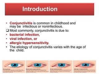 Introduction
• Conjunctivitis is common in childhood and
may be infectious or noninfectious.
 Most commonly, conjunctivitis is due to:
• bacterial infection,
• viral infection, or
• allergic hypersensitivity.
• The etiology of conjunctivitis varies with the age of
the child.
 