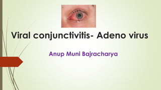 Viral conjunctivitis- Adeno virus
Anup Muni Bajracharya
 